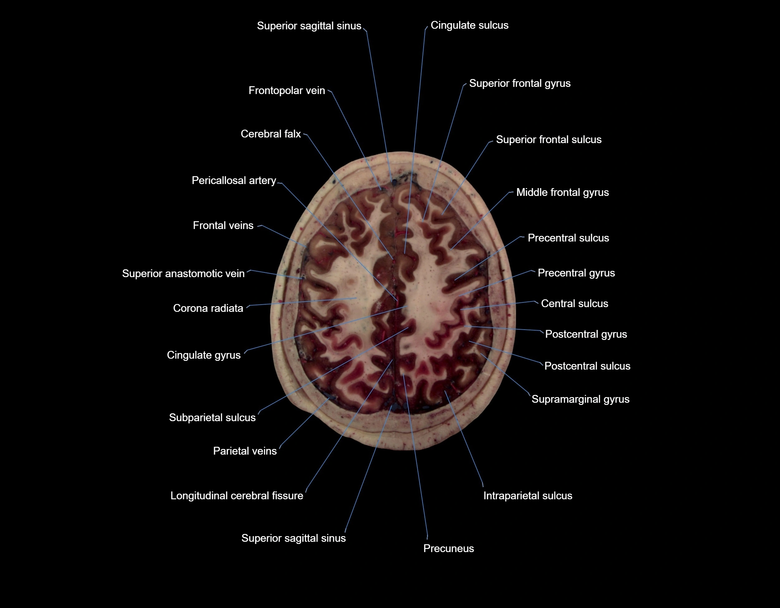 Visible-Human-Project-brain-Axial-cross-sectional-labelled-anatomy---img-000061.webp