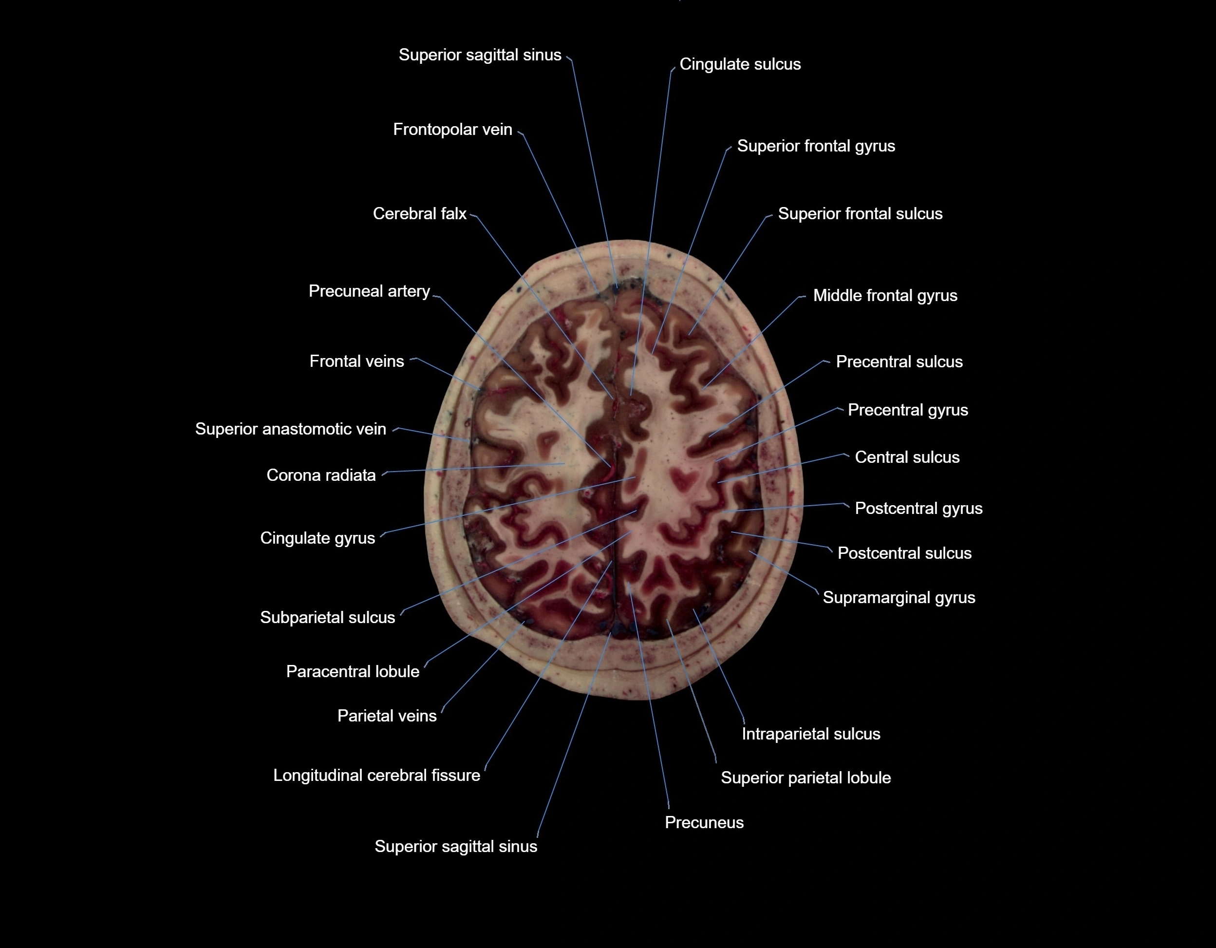 Visible-Human-Project-brain-Axial-cross-sectional-labelled-anatomy---img-000062.webp