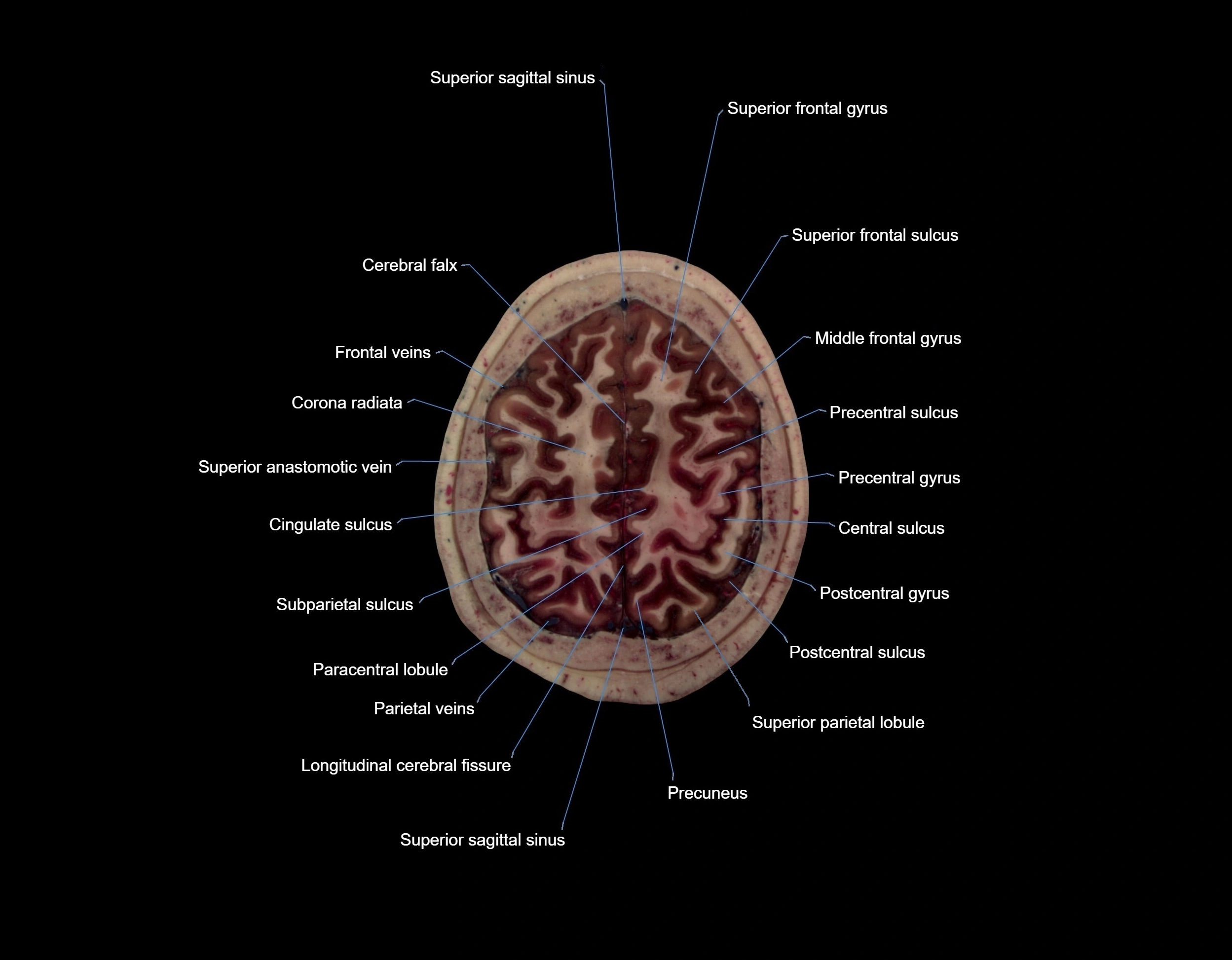 Visible-Human-Project-brain-Axial-cross-sectional-labelled-anatomy---img-000064.webp