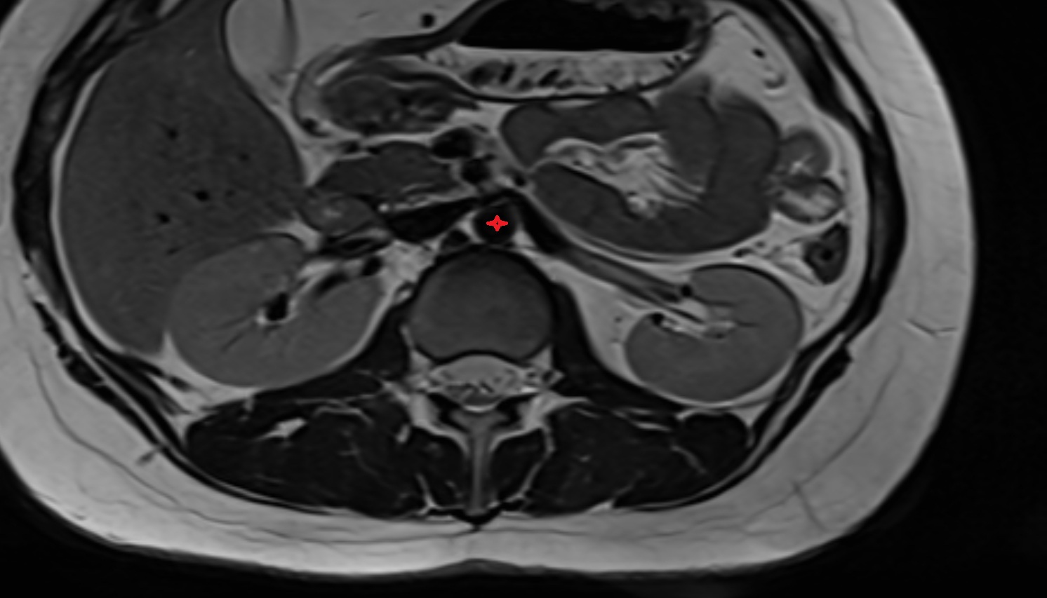 Abdominal aorta  anantomy  MRI  AXIAL  image -img-00000-00000