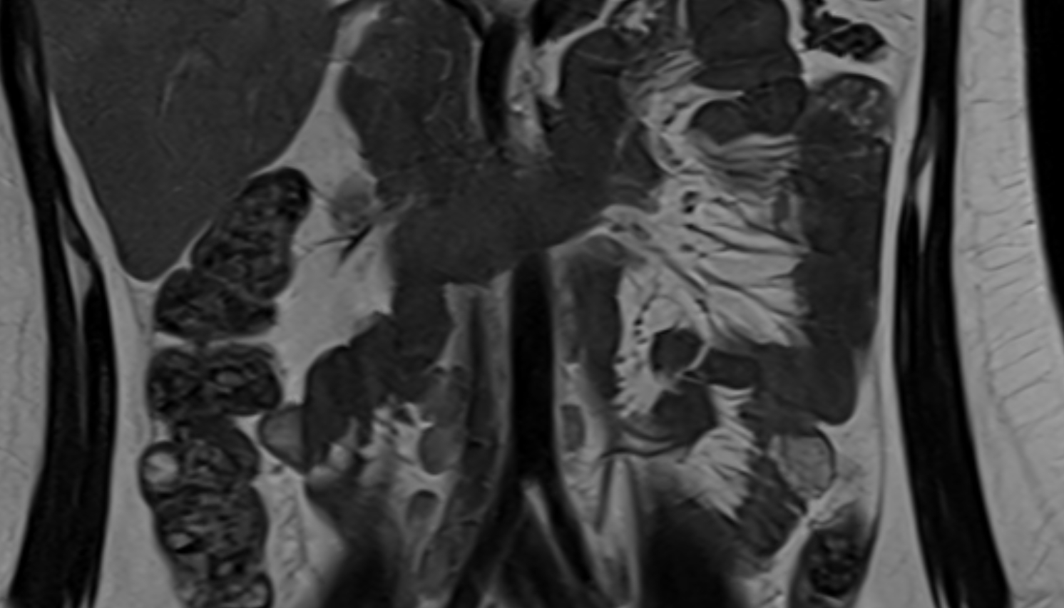 Abdominal aorta  anantomy  MRI coronal image -img-00000-00000