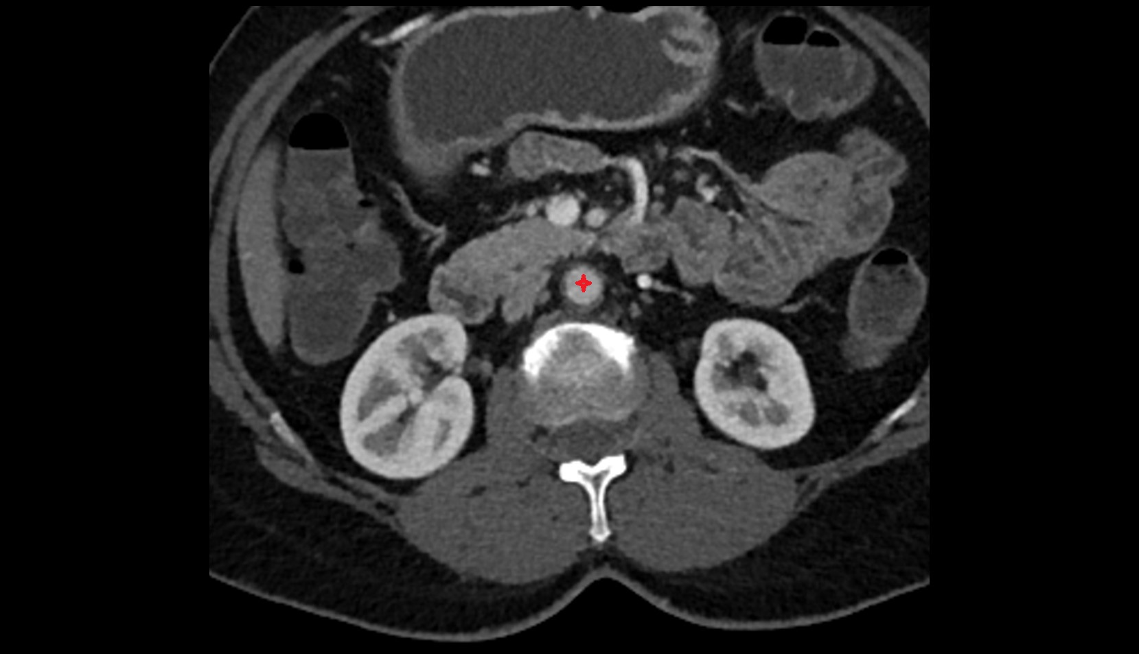 Abdominal aortact  axial image