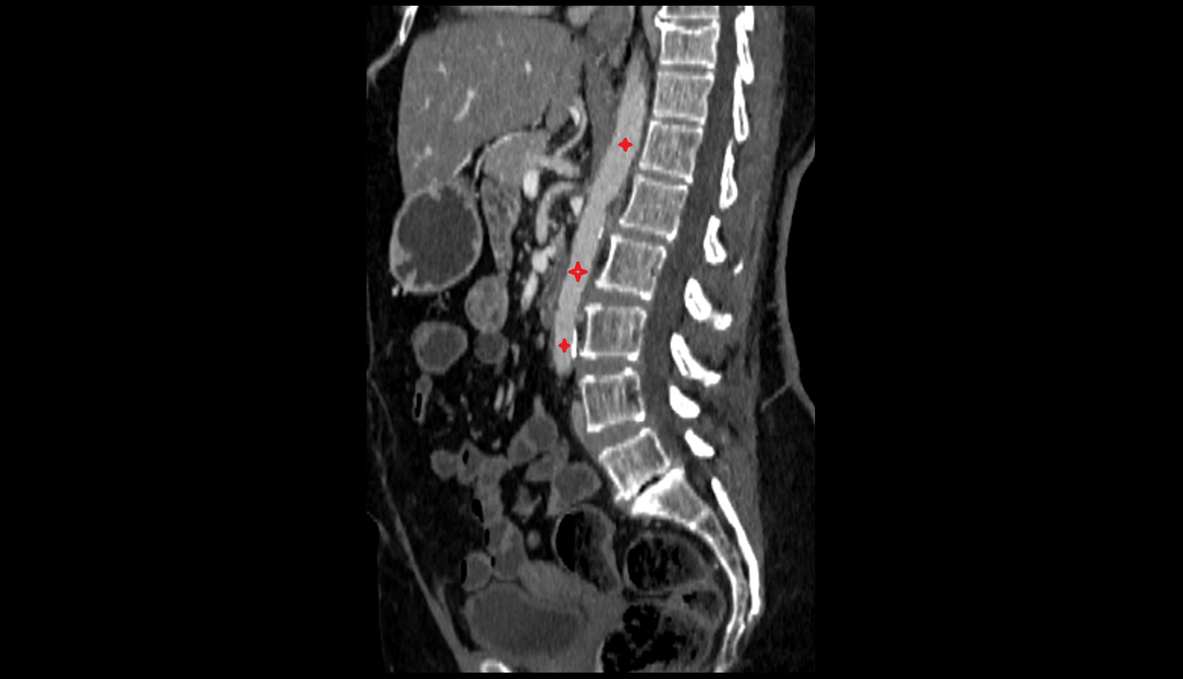 Abdominal aorta ct sag image
