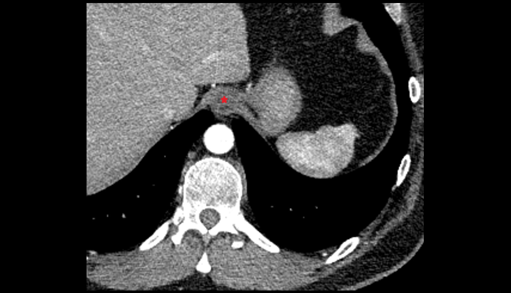 Abdominal part of esophagus ct axial image