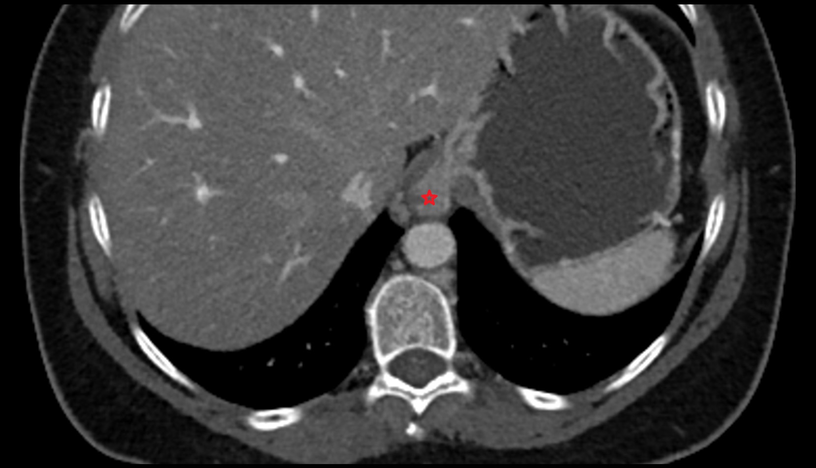 Abdominal part of esophagus ct axial image 1