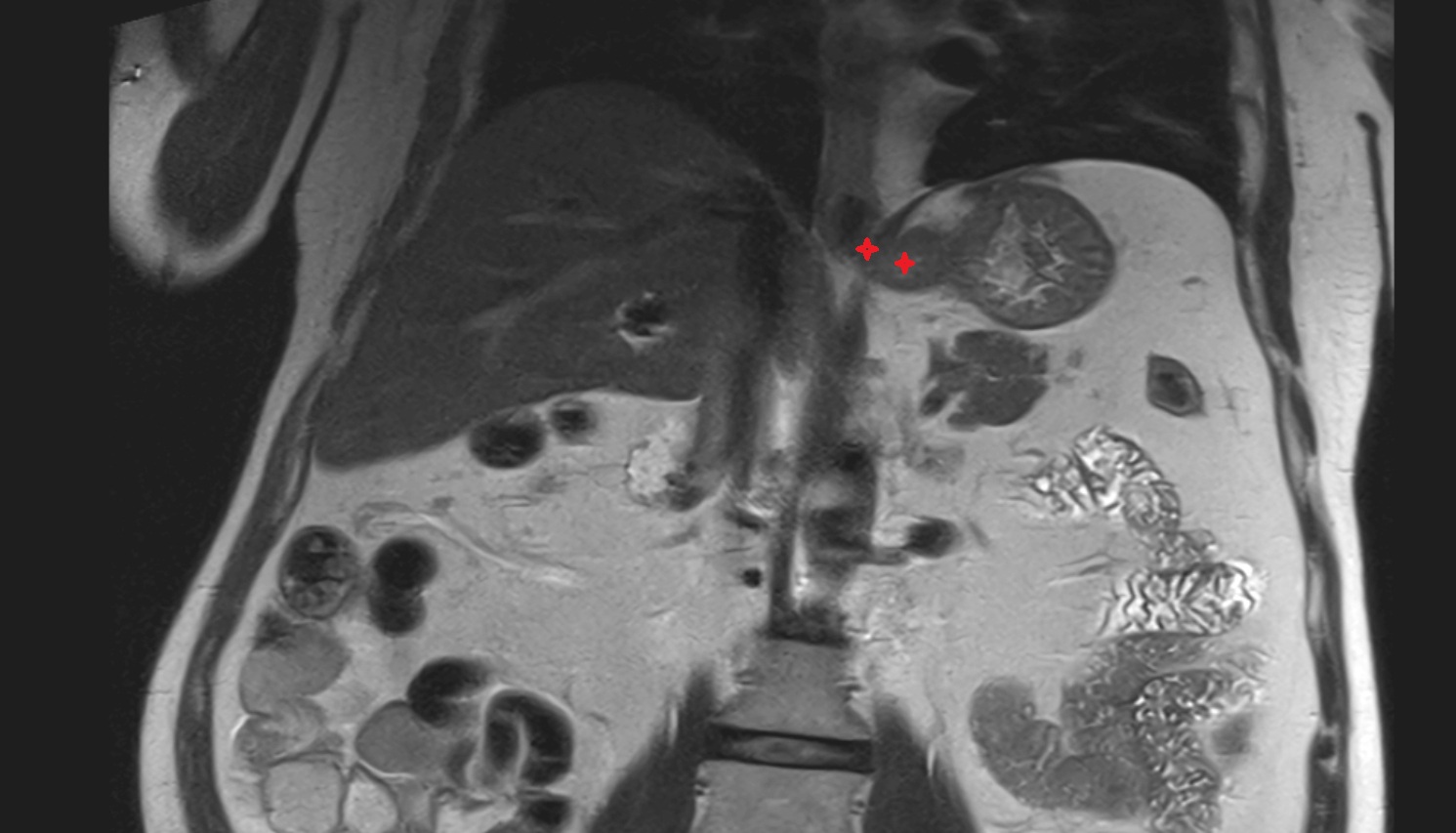 Abdominal part of esophagus ct axial image  MRI coronal  anatomy  image -img-00000-00000