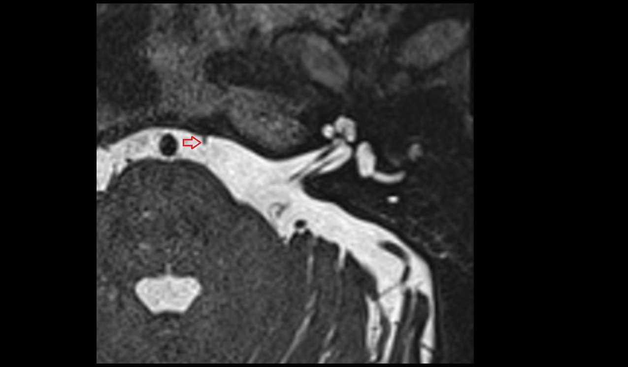Abducens nerve (Cranial nerve VI) MRI 3T axial image