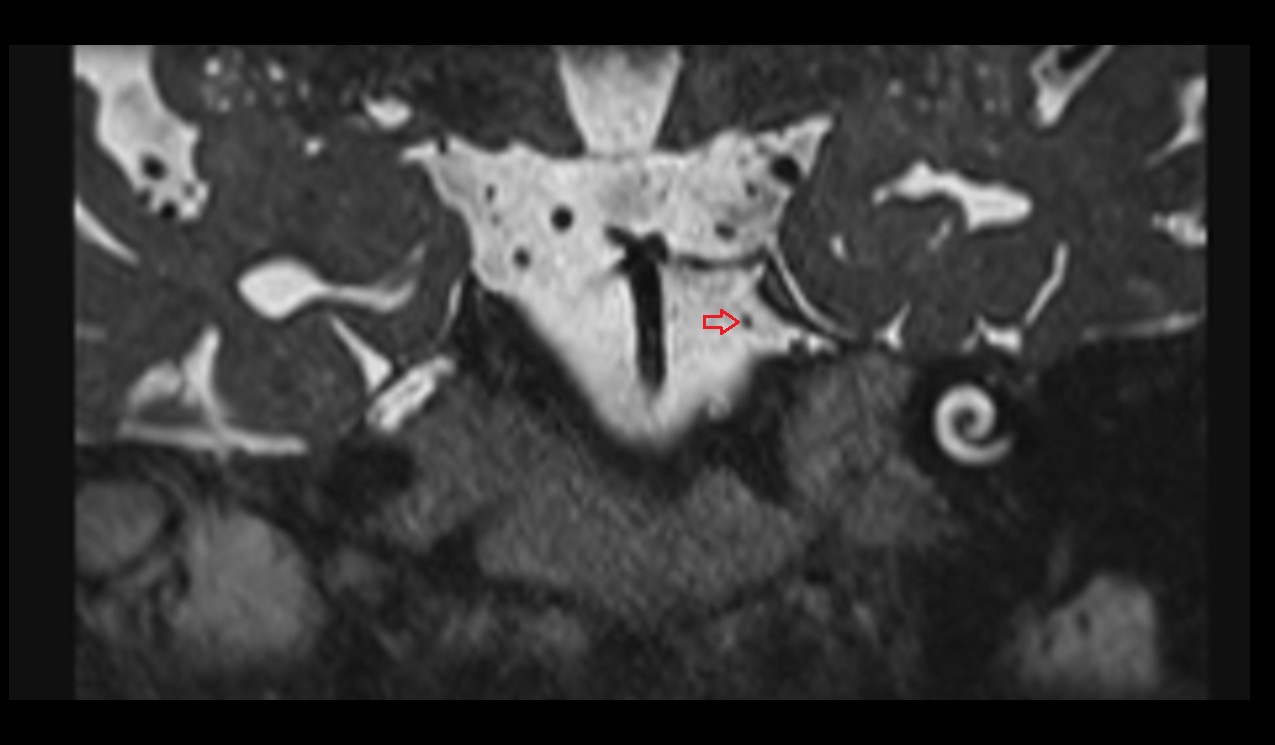 Abducens nerve (Cranial nerve VI) MRI 3T coronal image
