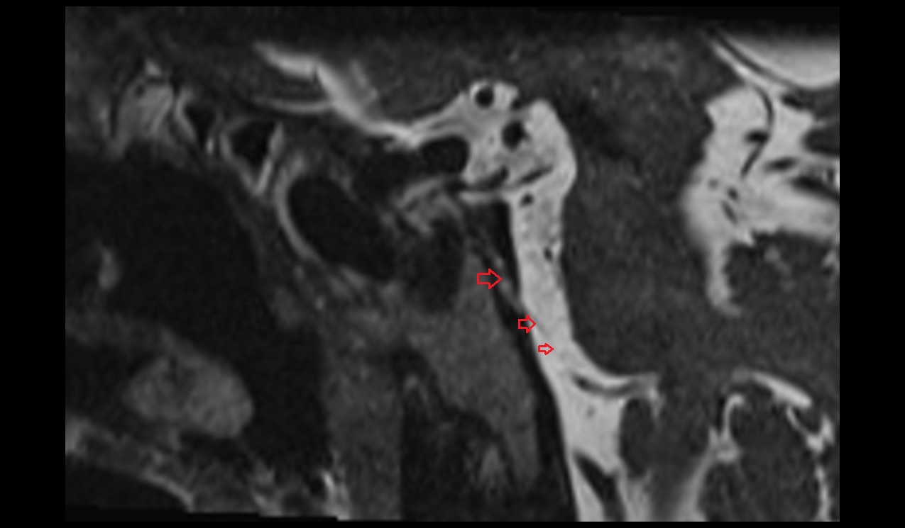 Abducens nerve (Cranial nerve VI) MRI 3T sagittal  image