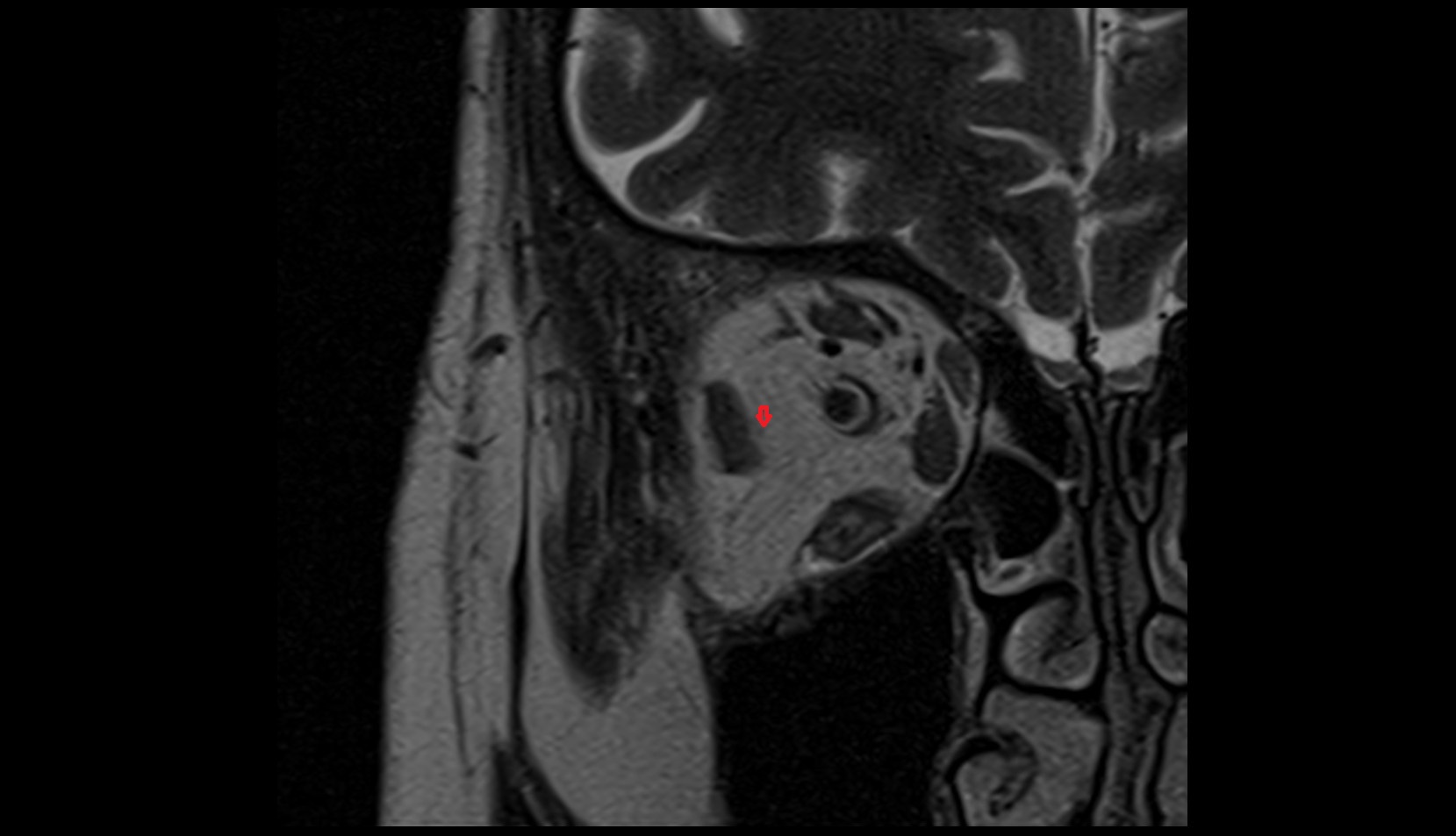 Abducens nerve mri image