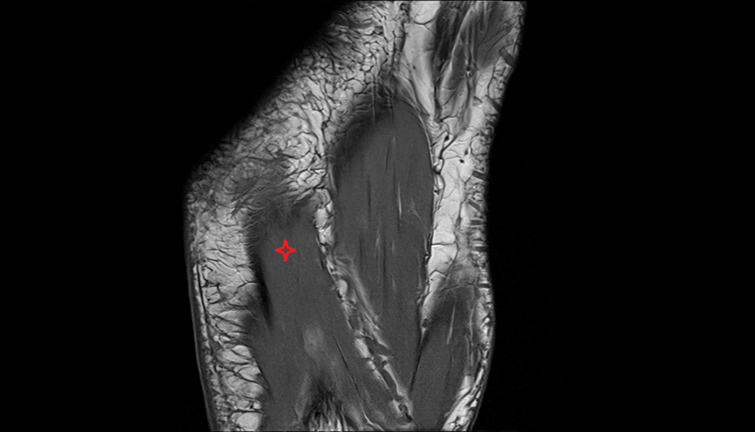 Abductor digiti minimi muscle CORONAL cross sectional anatomy 3T MRI AI enhanced radiology image-img-00000-00000