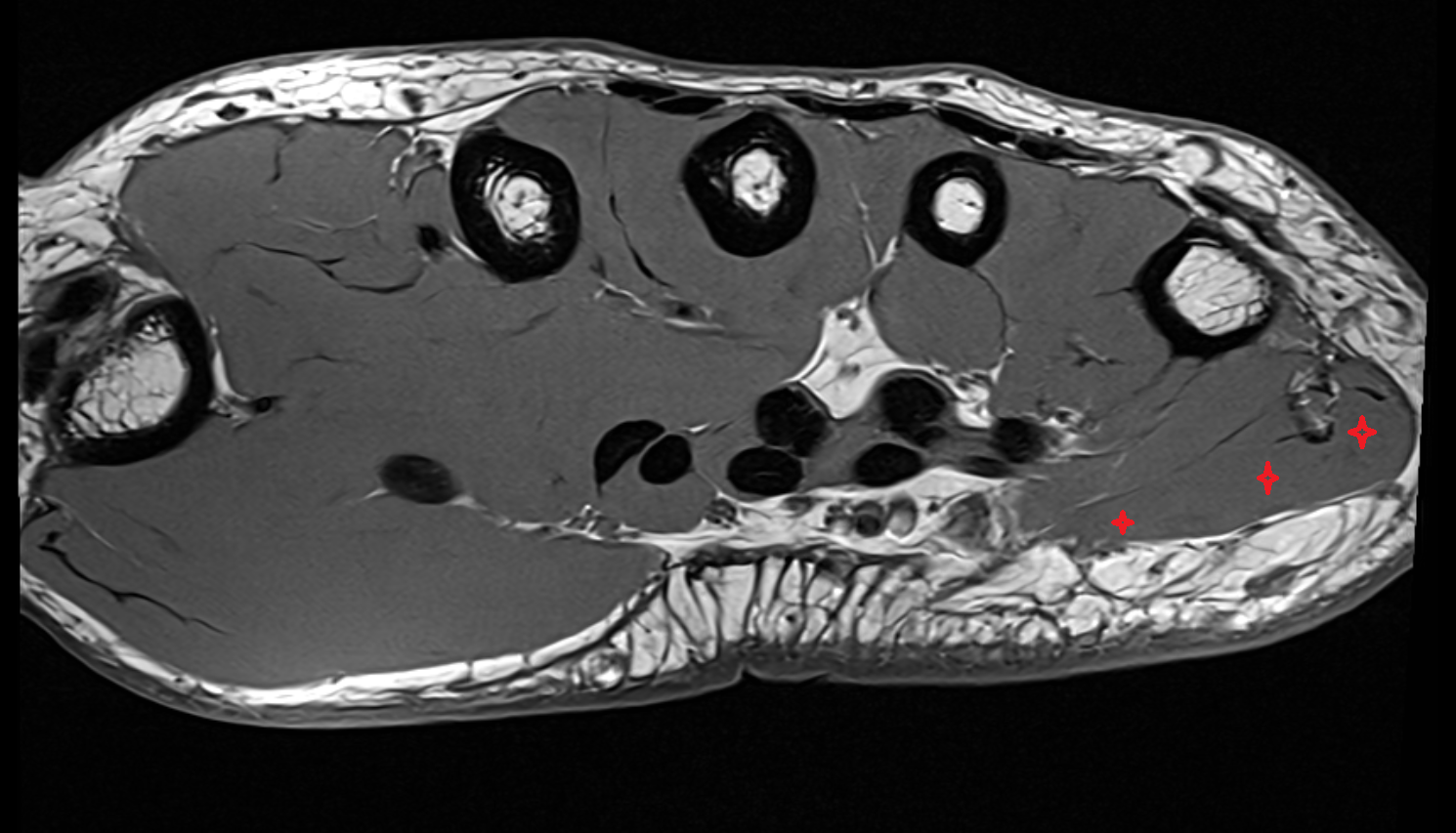 Abductor digiti minimi muscle axial cross sectional anatomy 3T MRI AI enhanced radiology image-img-00000-00000