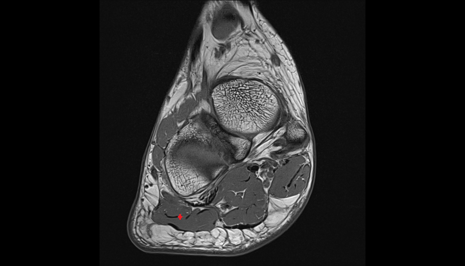 Abductor digiti minimi muscle axial cross sectional anatomy 3T MRI AI enhanced radiology image-img-00000-00000_00001