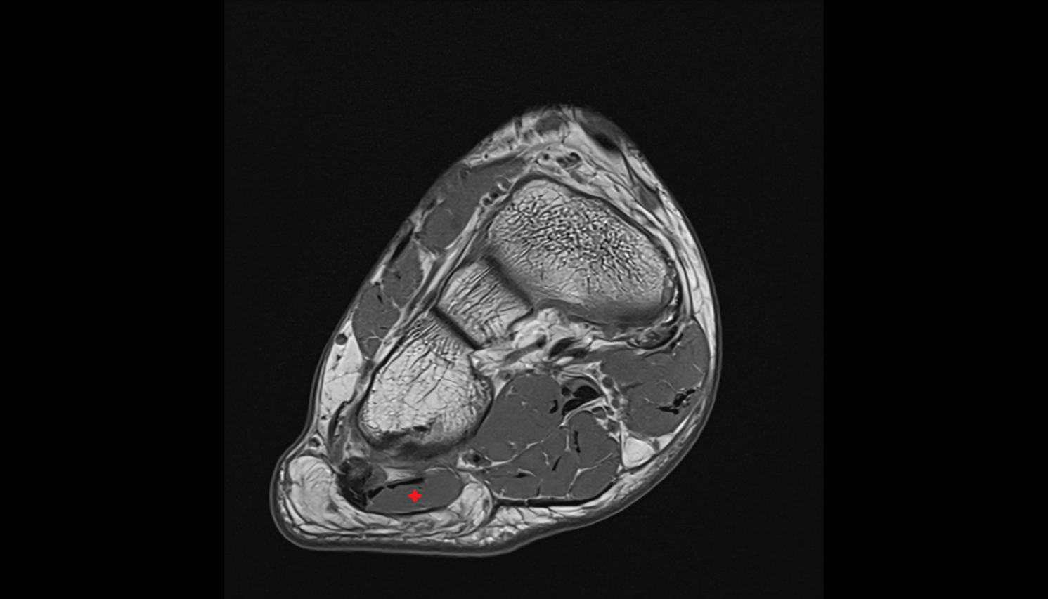 Abductor digiti minimi muscle axial cross sectional anatomy 3T MRI AI enhanced radiology image-img-00000-00000_00002