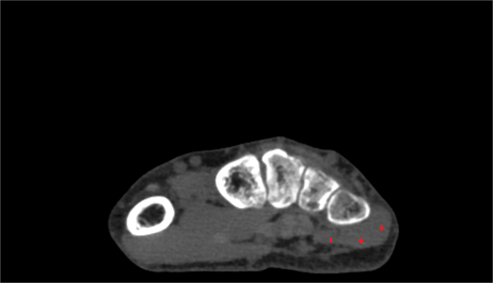 Abductor digiti minimi muscle axil ct image