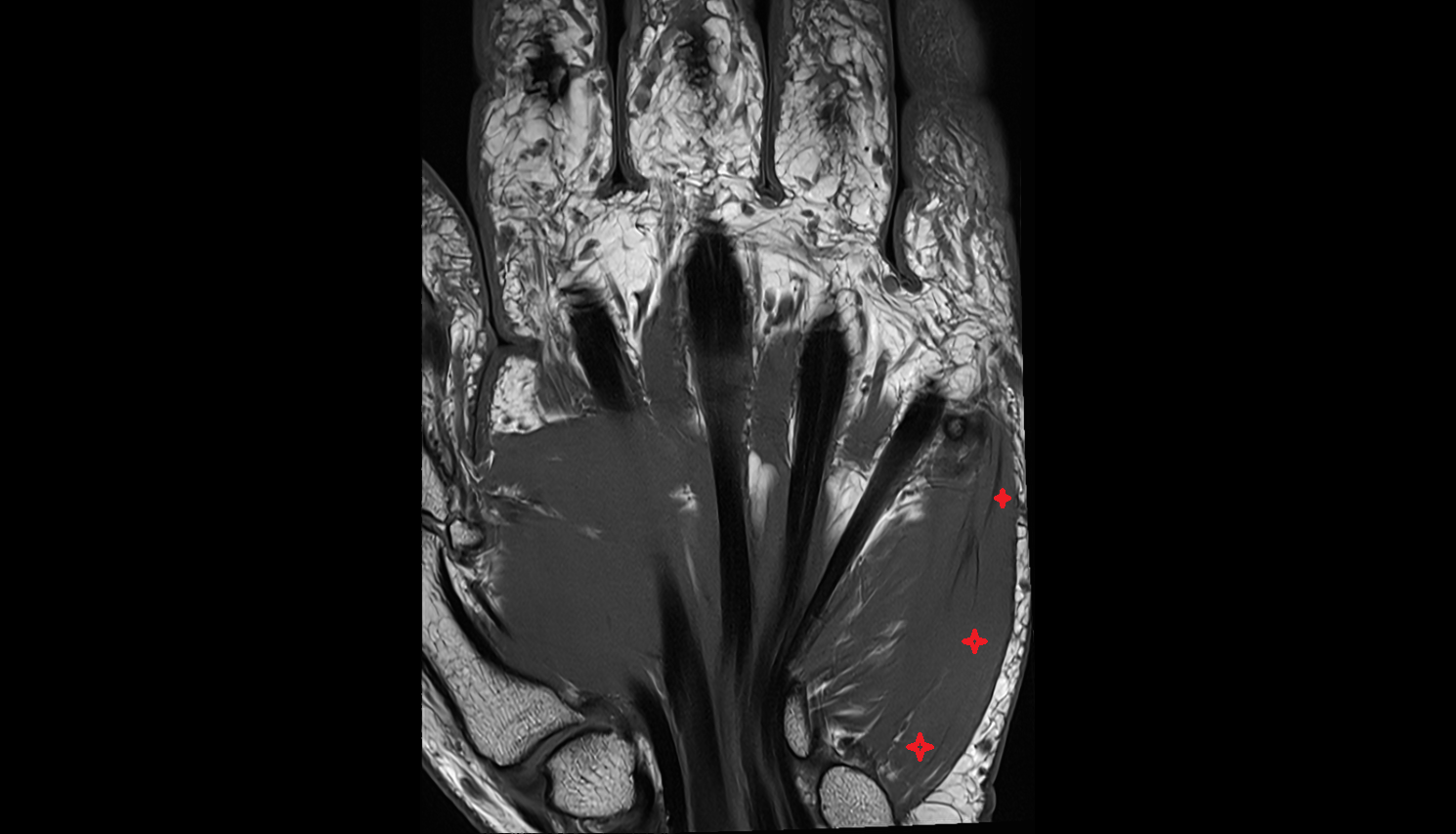 Abductor digiti minimi muscle coronal cross sectional anatomy 3T MRI AI enhanced radiology image-img-00000-00000