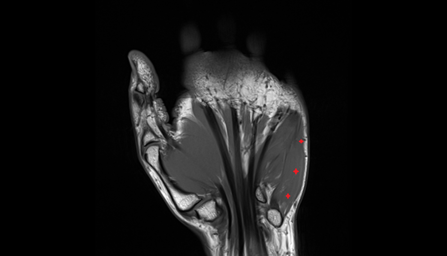 Abductor digiti minimi muscle coronal cross sectional anatomy 3T MRI AI enhanced radiology image-img-00000-00000_00001