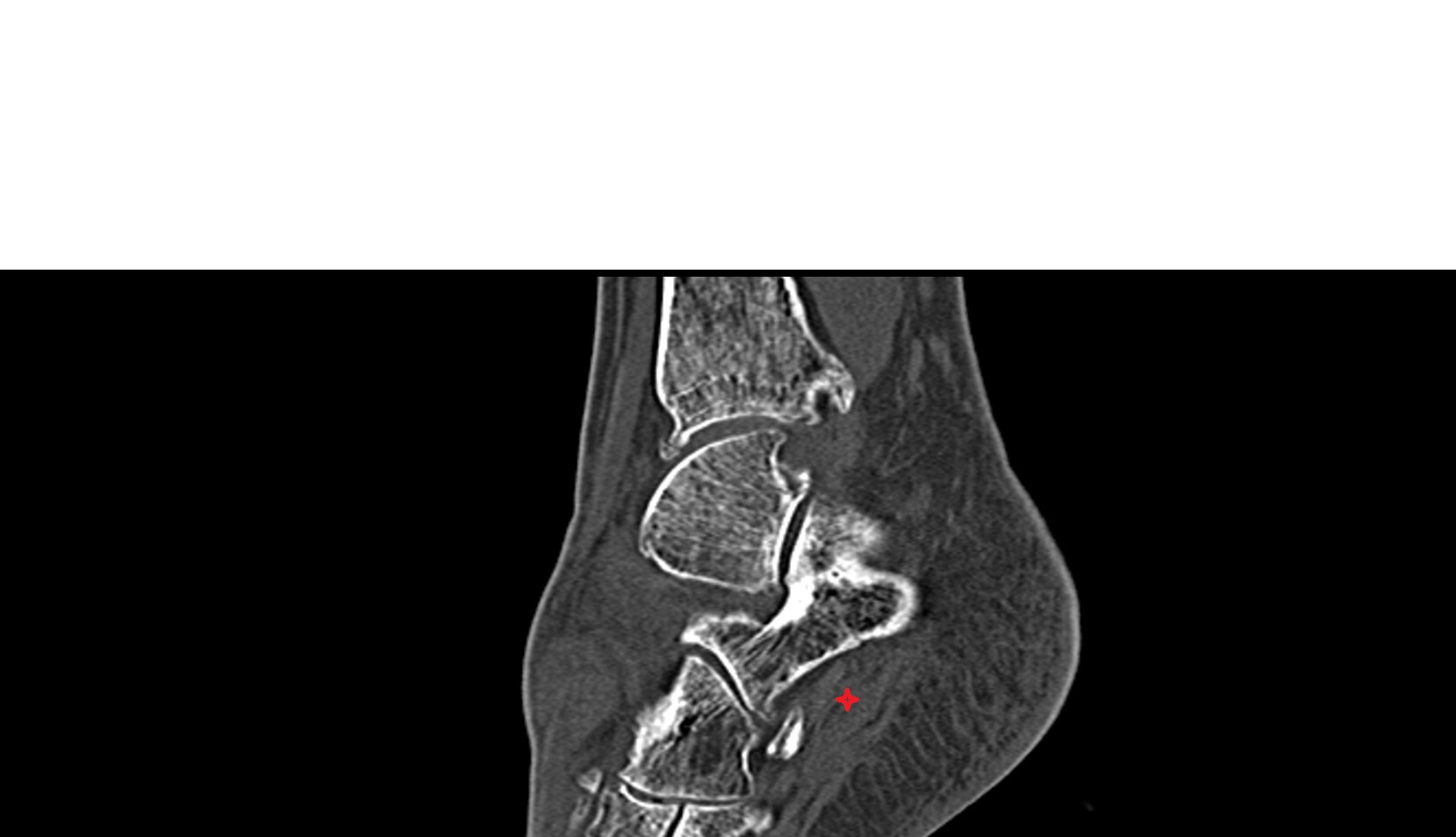 Abductor digiti minimi muscle ct sagittal image