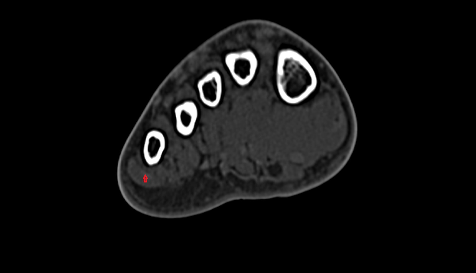 Abductor digiti minimi tendon ct axial