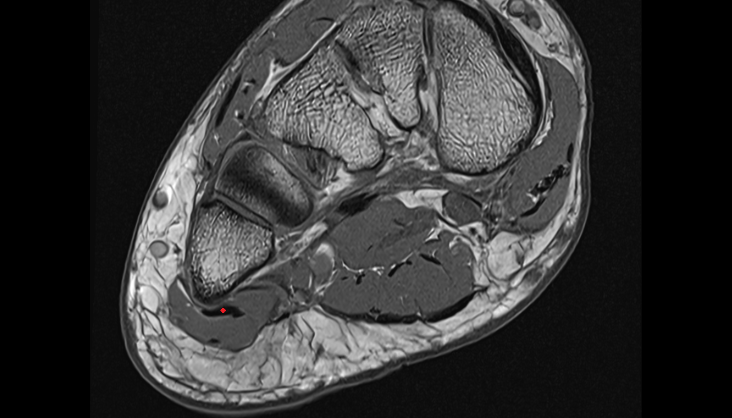 Abductor digiti minimi tendon  sfov  of the Foot axial cross sectional anatomy 3T MRI AI enhanced radiology image-img-00000-00000