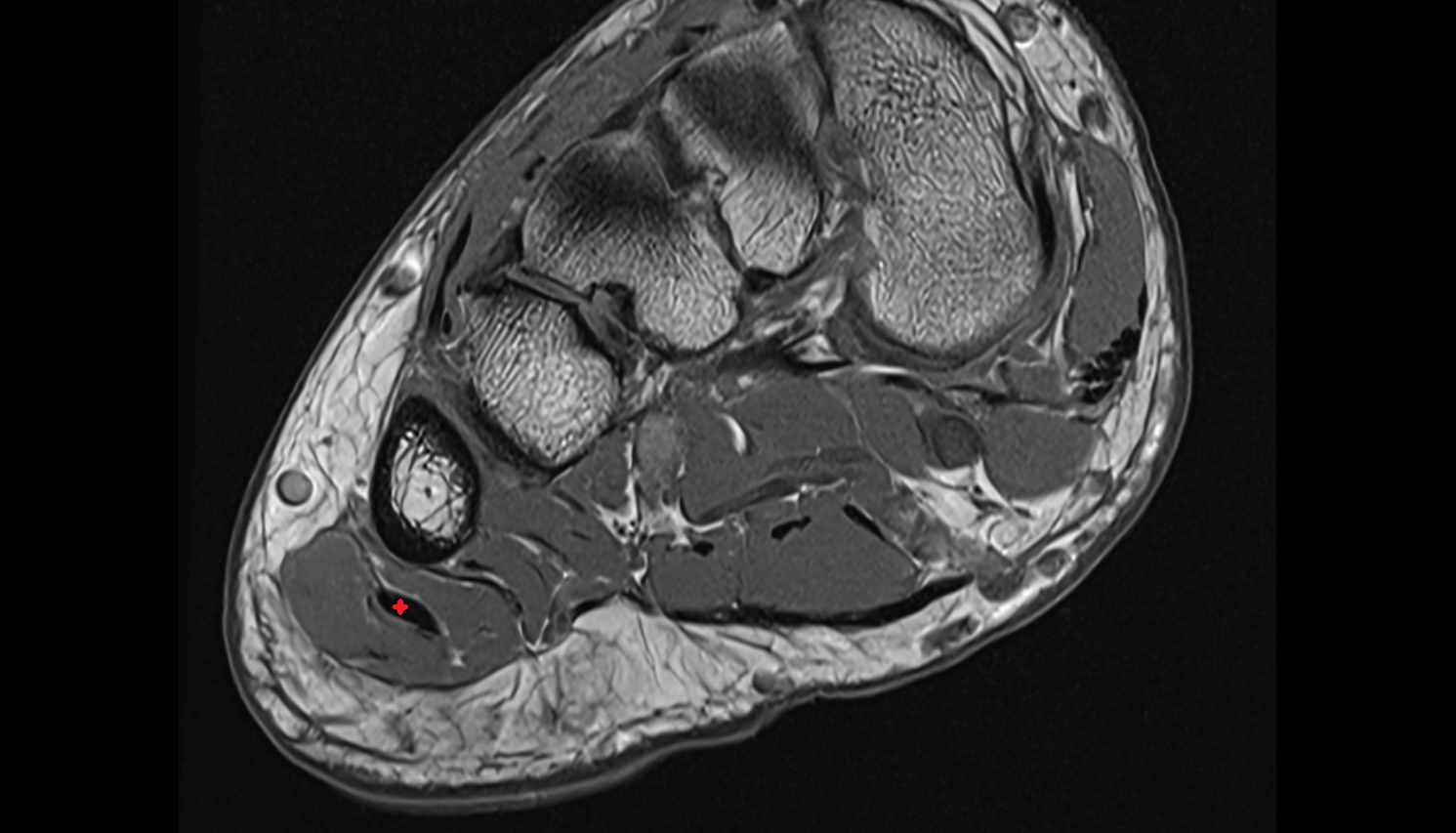 Abductor digiti minimi tendon  sfov  of the Foot axial cross sectional anatomy 3T MRI AI enhanced radiology image-img-00000-00000_00001