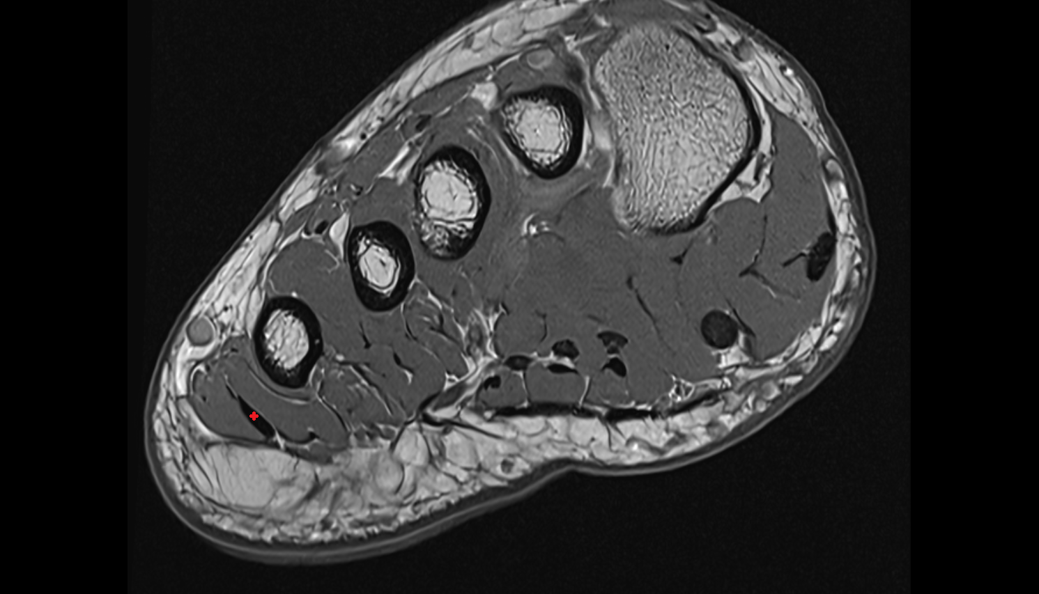 Abductor digiti minimi tendon  sfov  of the Foot axial cross sectional anatomy 3T MRI AI enhanced radiology image-img-00000-00000_00002