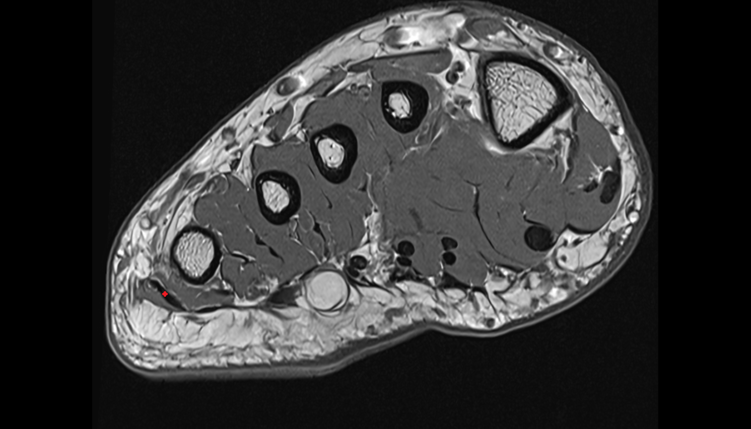 Abductor digiti minimi tendon  sfov  of the Foot axial cross sectional anatomy 3T MRI AI enhanced radiology image-img-00000-00000_00003