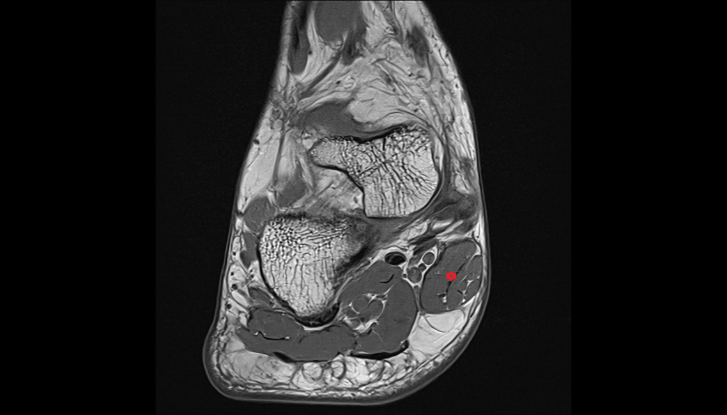 Abductor hallucis muscle axial cross sectional anatomy 3T MRI AI enhanced radiology image-img-00000-00000