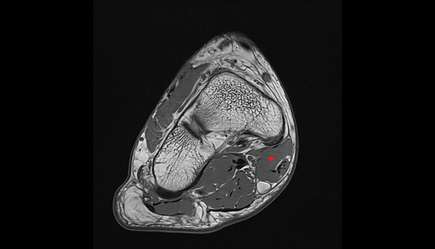 Abductor hallucis muscle axial cross sectional anatomy 3T MRI AI enhanced radiology image-img-00000-00000_00001