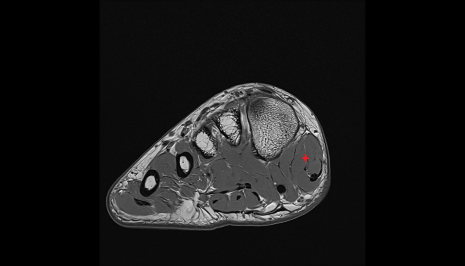 Abductor hallucis muscle axial cross sectional anatomy 3T MRI AI enhanced radiology image-img-00000-00000_00002