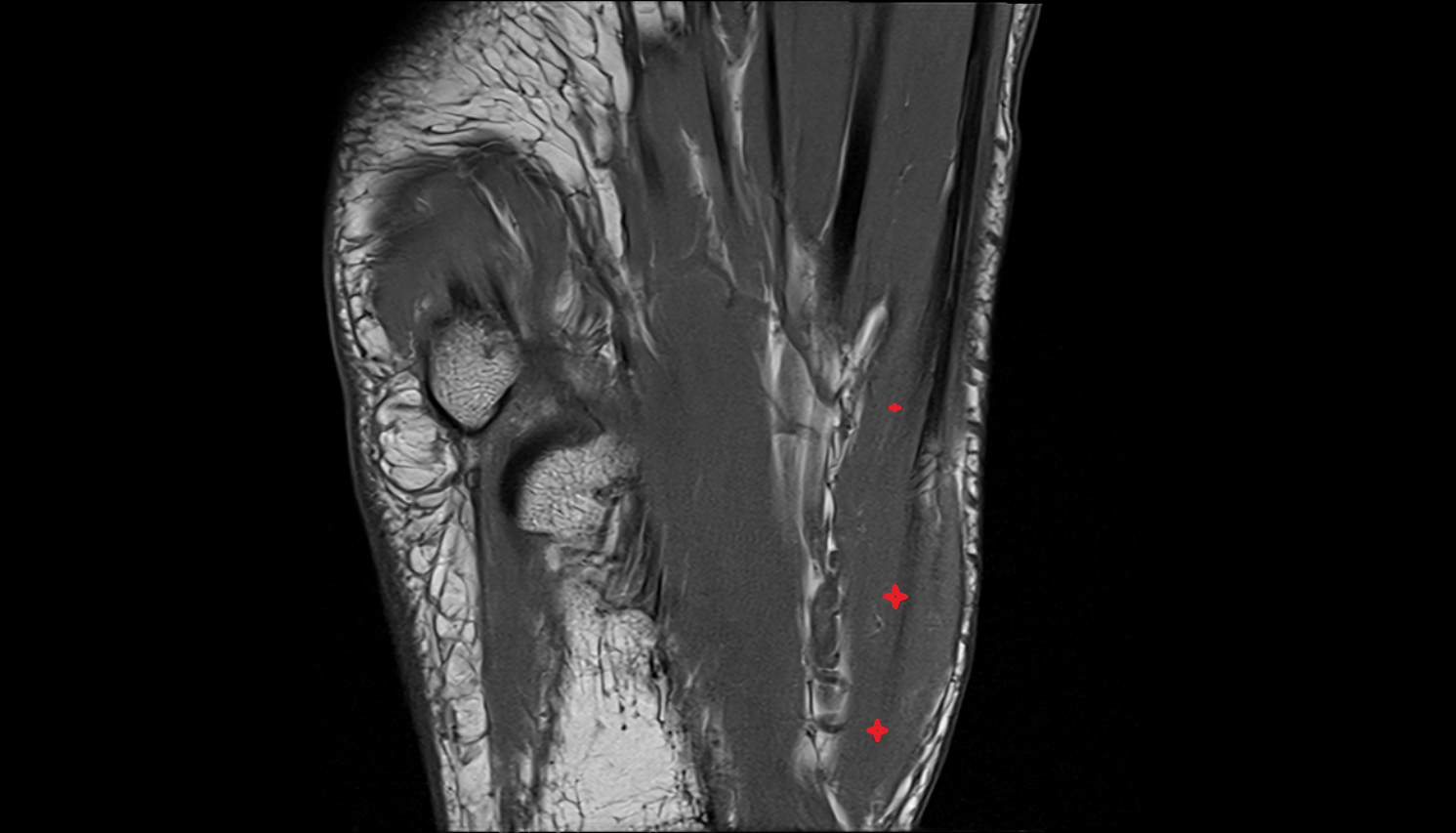 Abductor hallucis muscle coronal cross sectional anatomy 3T MRI AI enhanced radiology image-img-00000-00000