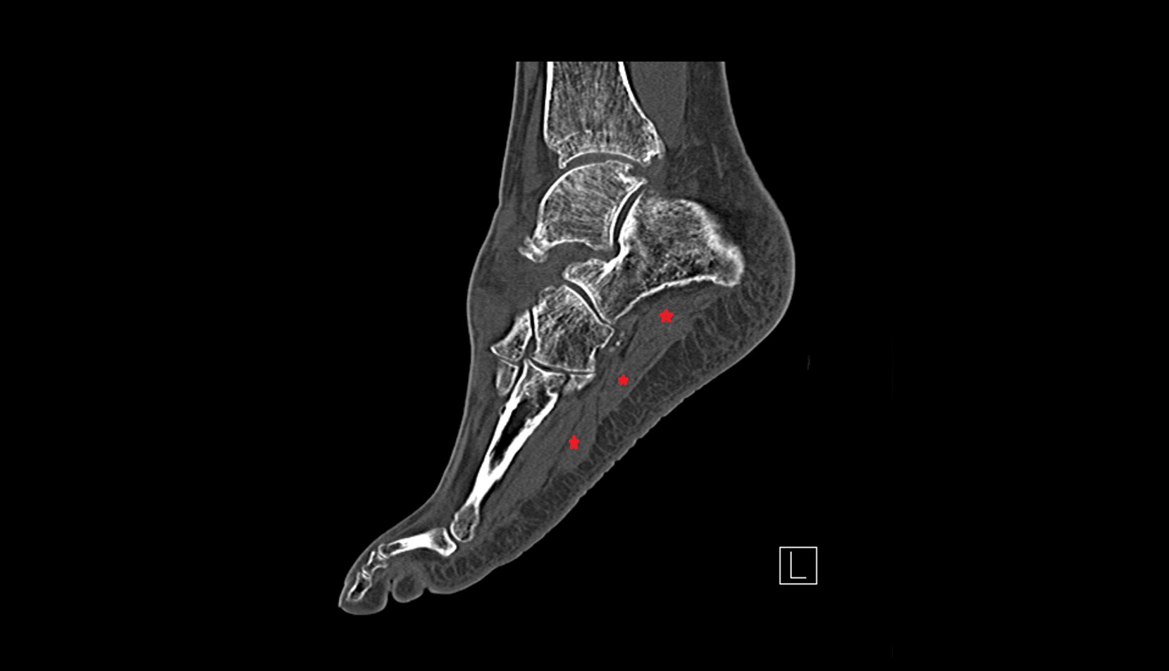 Abductor hallucis muscle ct sagittal image