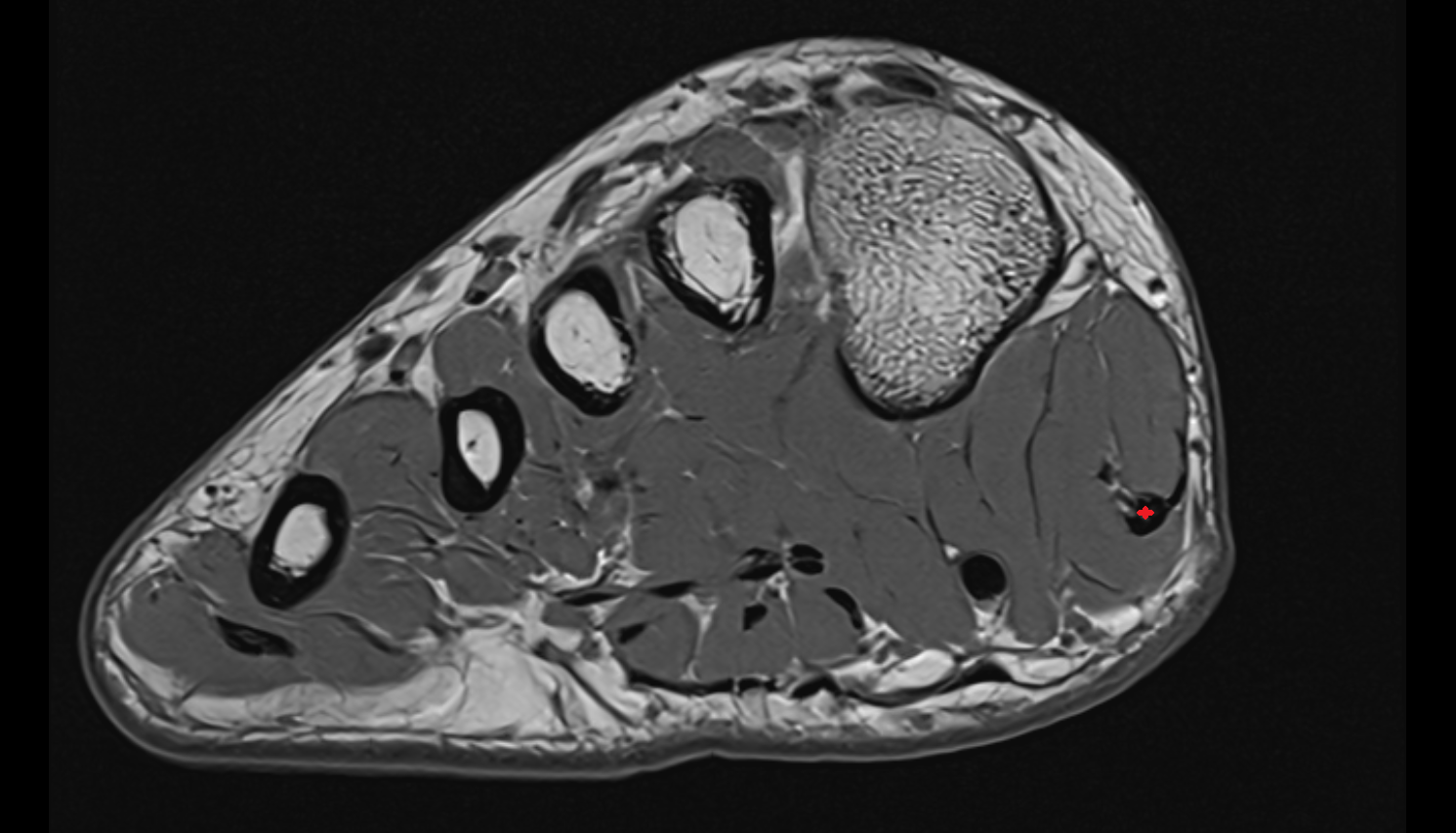 Abductor hallucis tendon  axial cross sectional anatomy 3T MRI AI enhanced radiology image-img-00000-00000