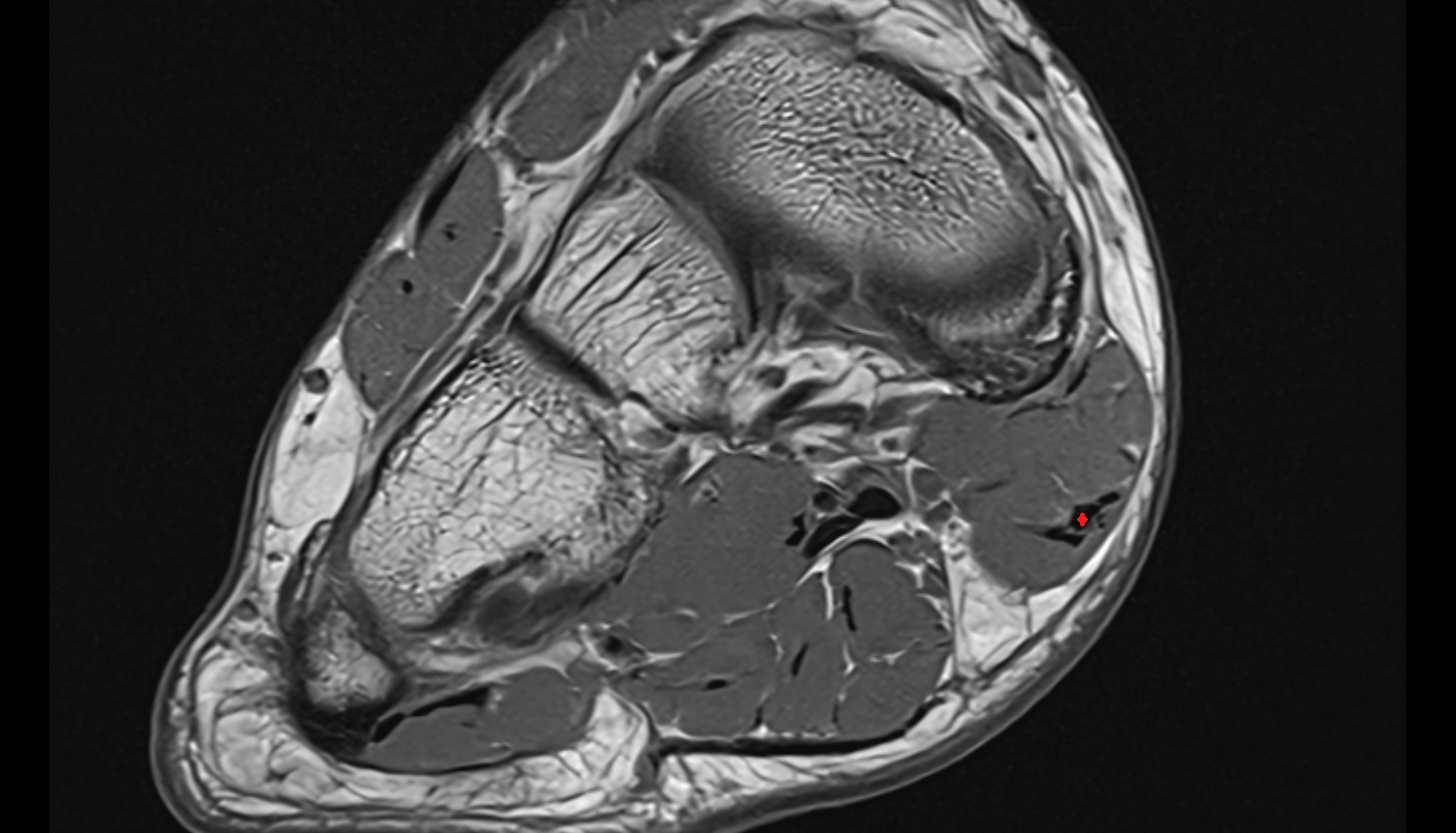 Abductor hallucis tendon  axial cross sectional anatomy 3T MRI AI enhanced radiology image-img-00000-00000_00001