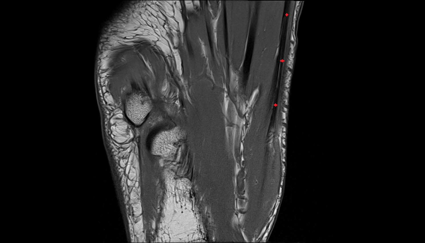 Abductor hallucis tendon  coronal cross sectional anatomy 3T MRI AI enhanced radiology image-img-00000-00000