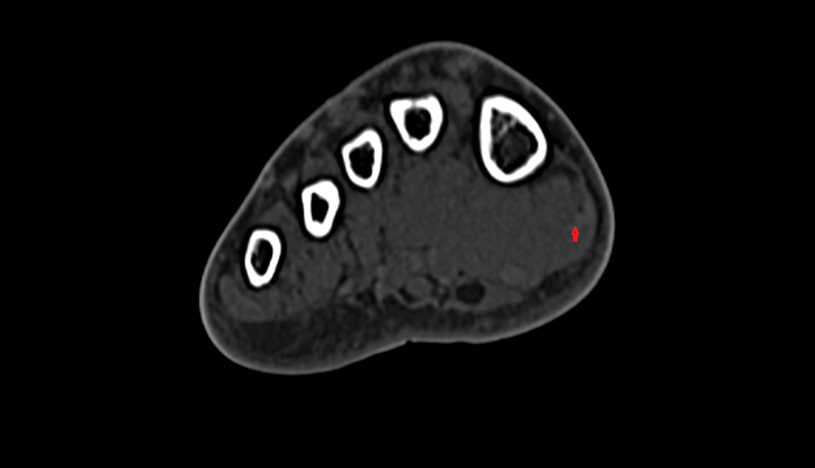 Abductor hallucis tendon ct axial