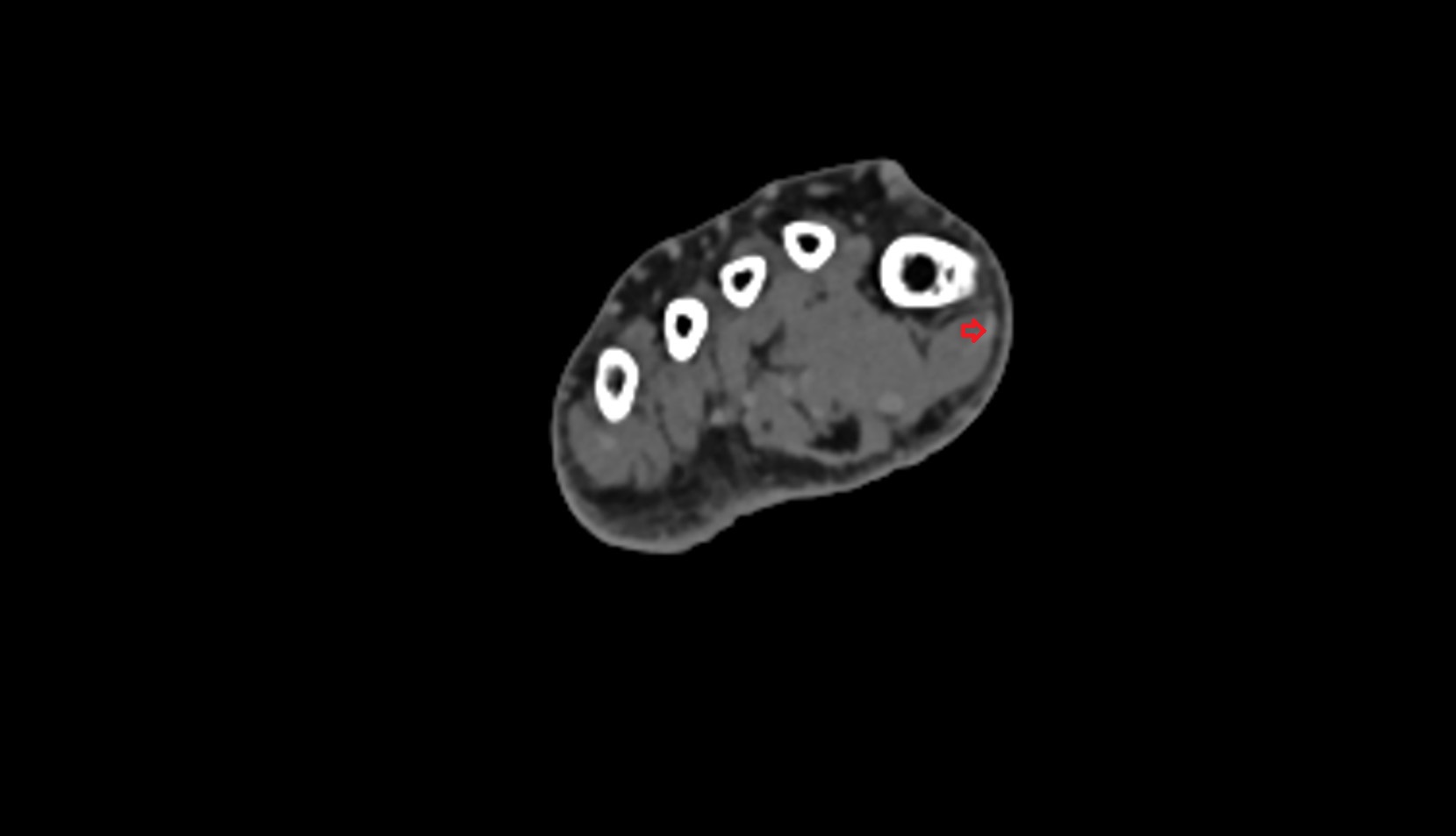 Abductor hallucis tendon ct axial image 1