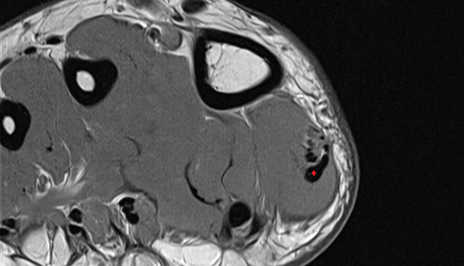 Abductor hallucis tendon  sfov  of the Foot axial cross sectional anatomy 3T MRI AI enhanced radiology image-img-00000-00000