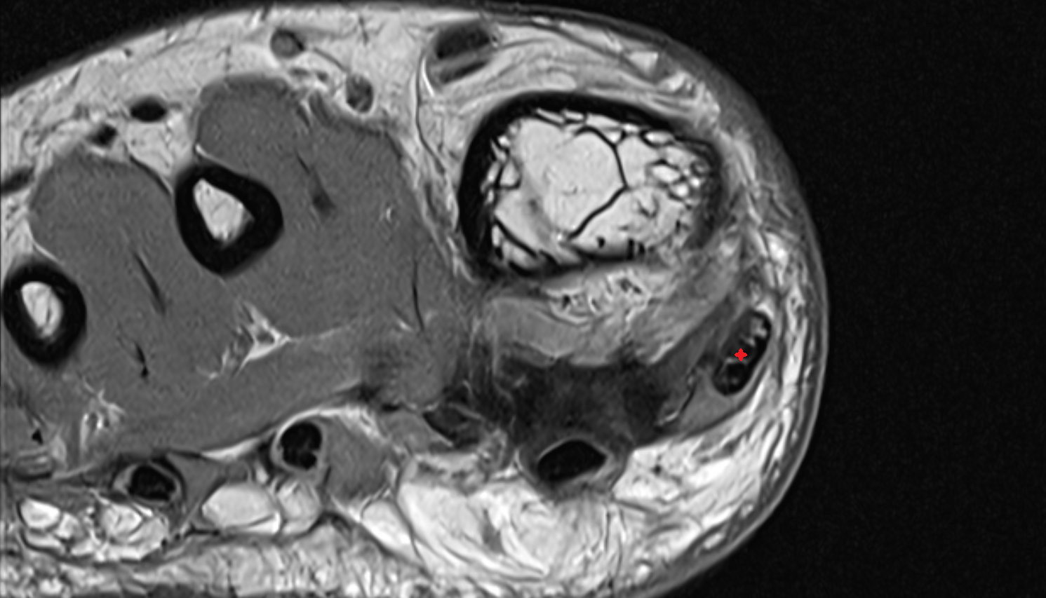 Abductor hallucis tendon  sfov  of the Foot axial cross sectional anatomy 3T MRI AI enhanced radiology image-img-00000-00000_00001