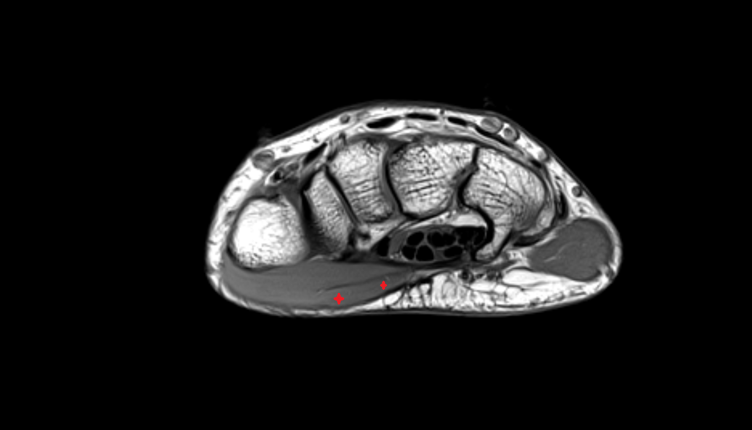 Abductor pollicis brevis axial cross sectional anatomy 3T MRI AI enhanced radiology image-img-00000-00000