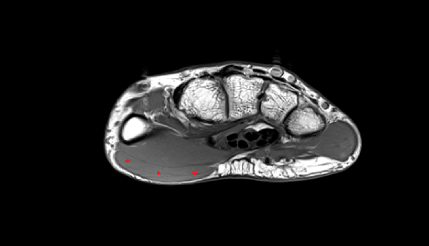 Abductor pollicis brevis axial cross sectional anatomy 3T MRI AI enhanced radiology image-img-00000-00000_00001