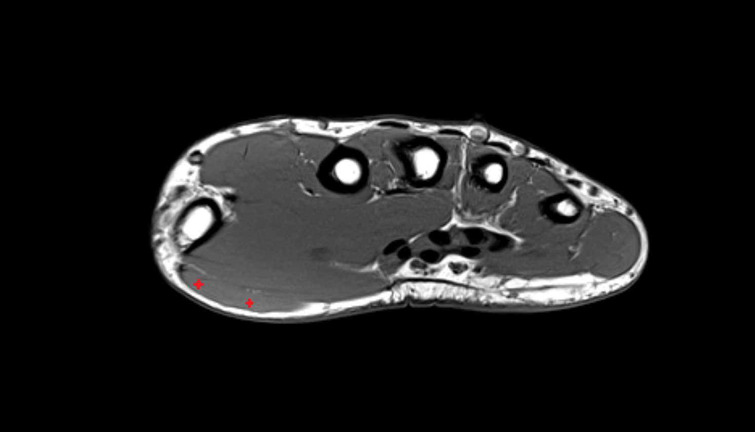 Abductor pollicis brevis axial cross sectional anatomy 3T MRI AI enhanced radiology image-img-00000-00000_00002