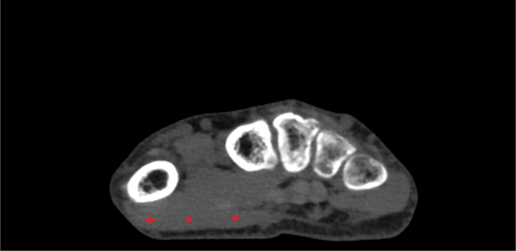 Abductor pollicis brevis ct axial image