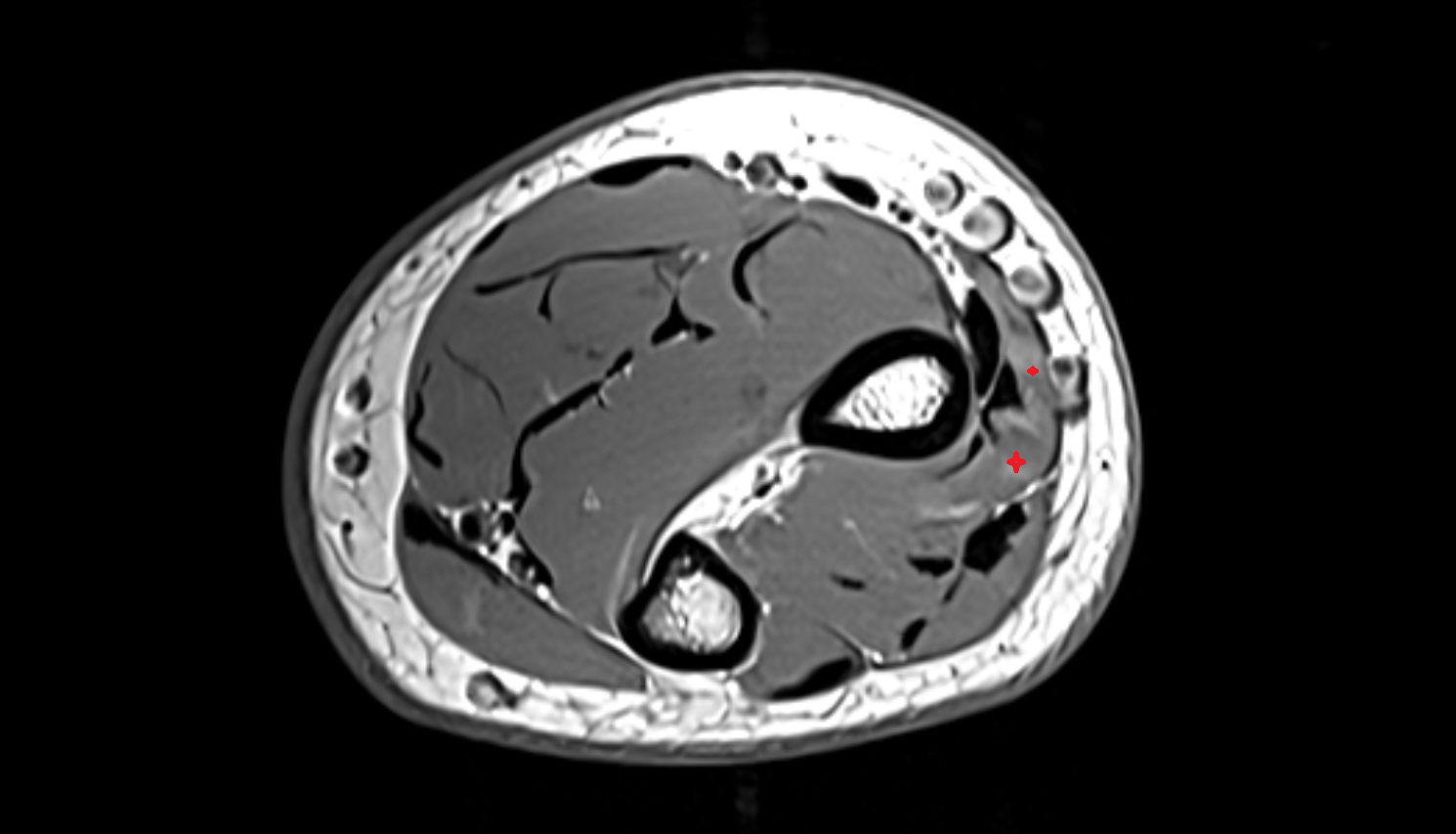 Abductor pollicis longus  axial cross sectional anatomy 3T MRI AI enhanced radiology image-img-00000-00000
