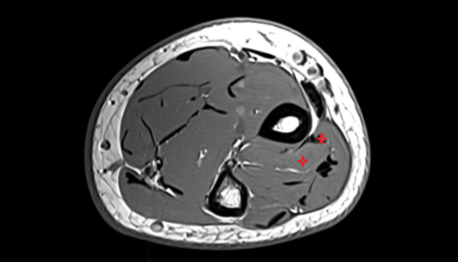 Abductor pollicis longus  axial cross sectional anatomy 3T MRI AI enhanced radiology image-img-00000-00000_00001