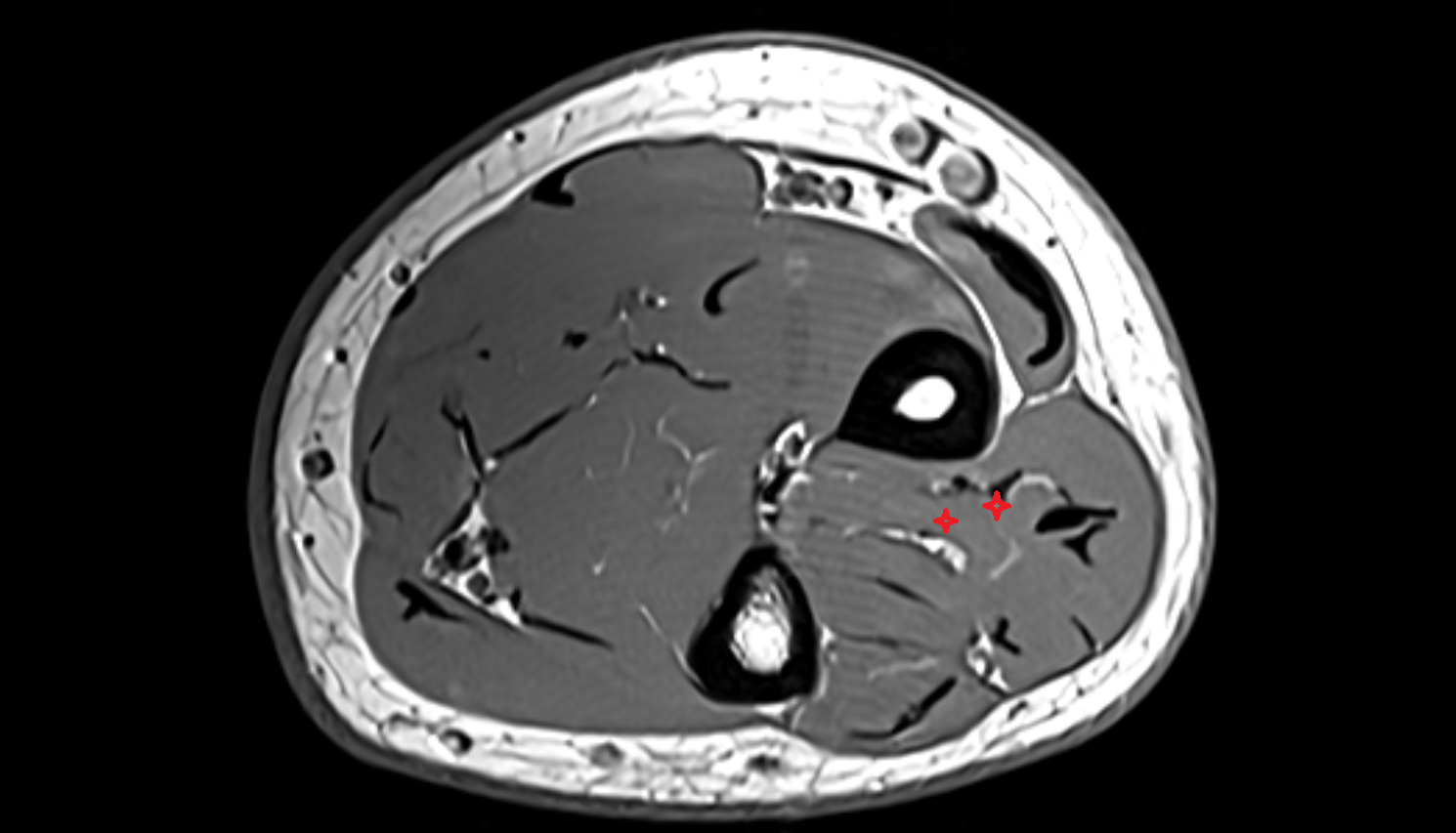 Abductor pollicis longus  axial cross sectional anatomy 3T MRI AI enhanced radiology image-img-00000-00000_00002