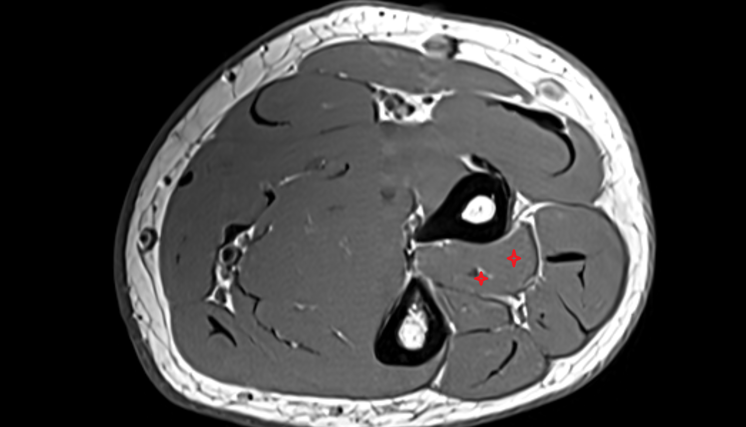 Abductor pollicis longus  axial cross sectional anatomy 3T MRI AI enhanced radiology image-img-00000-00000_00003