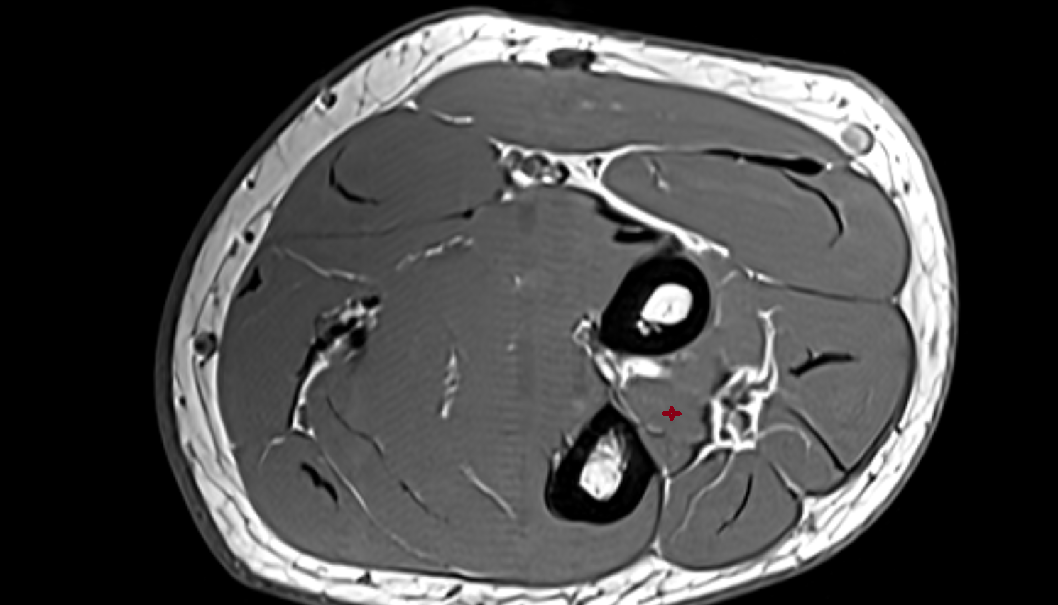 Abductor pollicis longus  axial cross sectional anatomy 3T MRI AI enhanced radiology image-img-00000-00000_00004