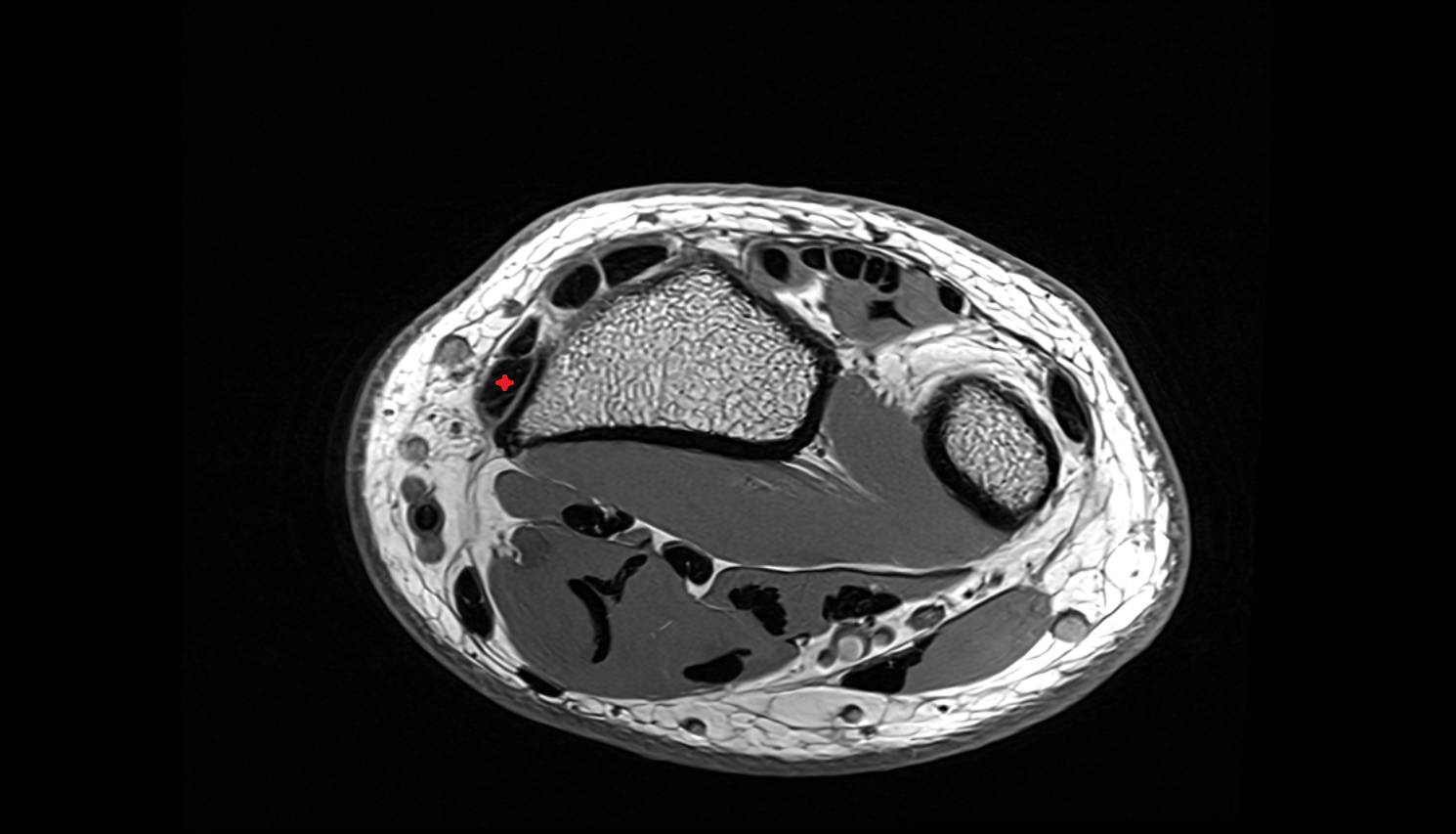 Abductor pollicis longus tendon axial cross sectional anatomy 3T MRI AI enhanced radiology image-img-00000-00000
