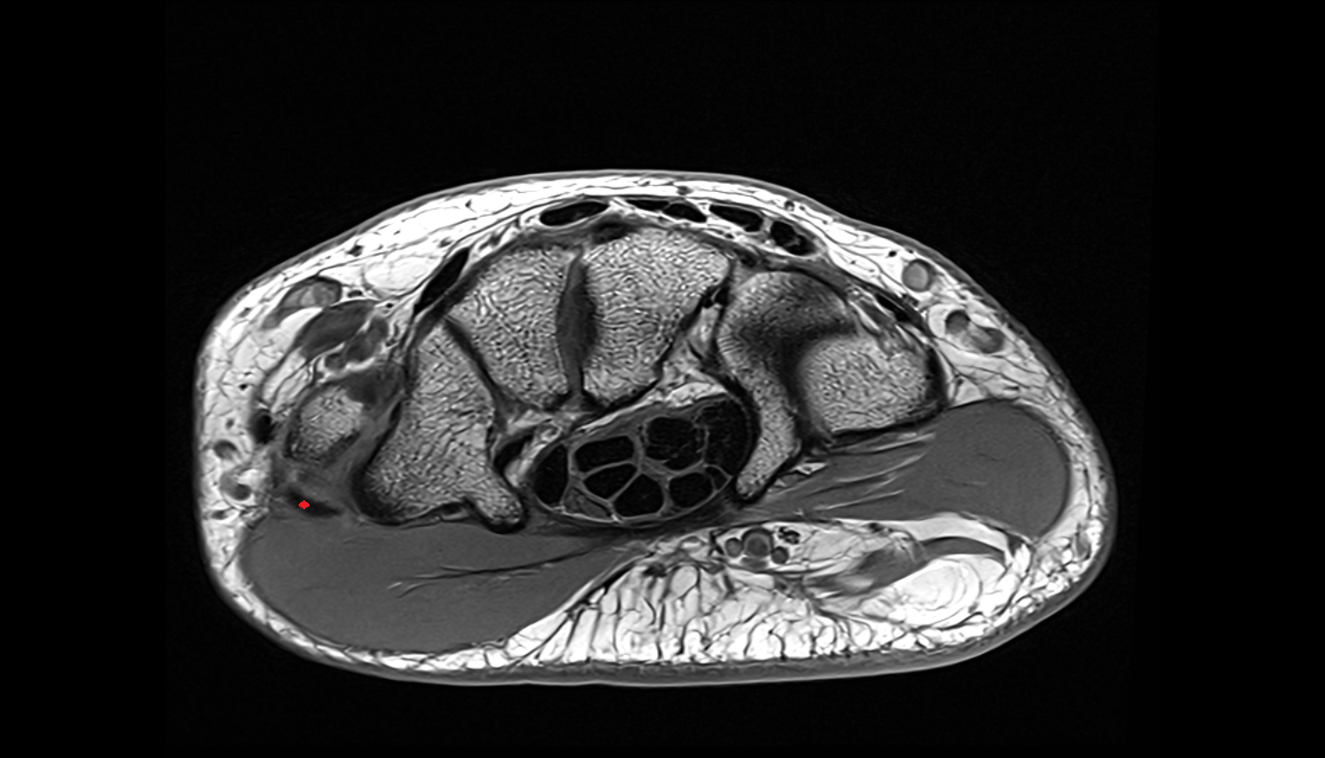 Abductor pollicis longus tendon axial cross sectional anatomy 3T MRI AI enhanced radiology image-img-00000-00000_00002